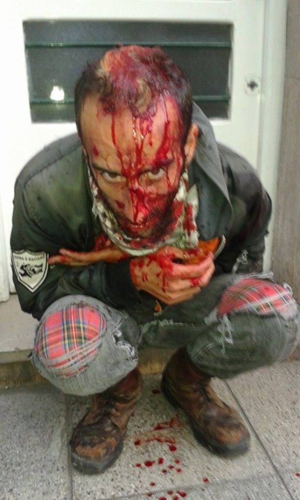 Lucas Baima, militante anfifascista, luego de ser agredido con caños rellenos de cemento